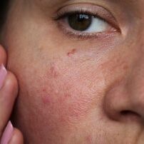 burst capillaries on the girl's face